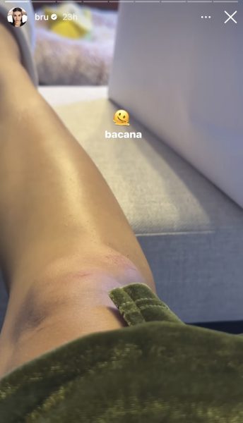 Bruna Gomes mostra joelho inchado